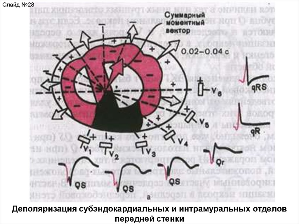 Ишемия переднебоковой стенки