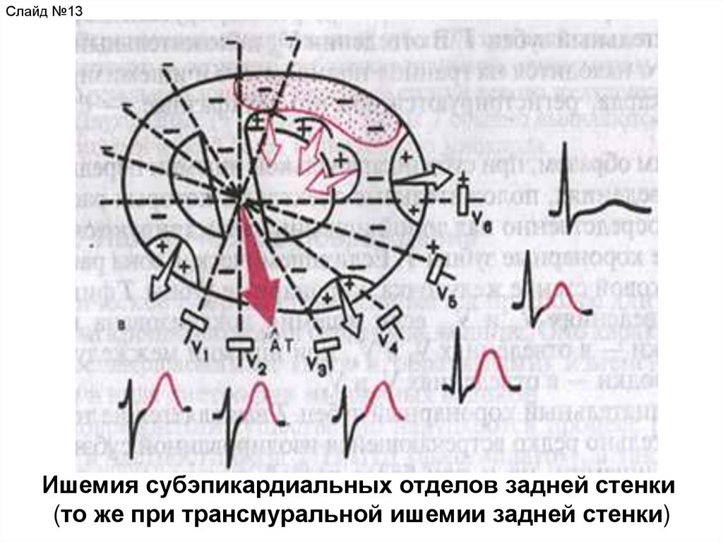 Ишемия переднебоковой стенки