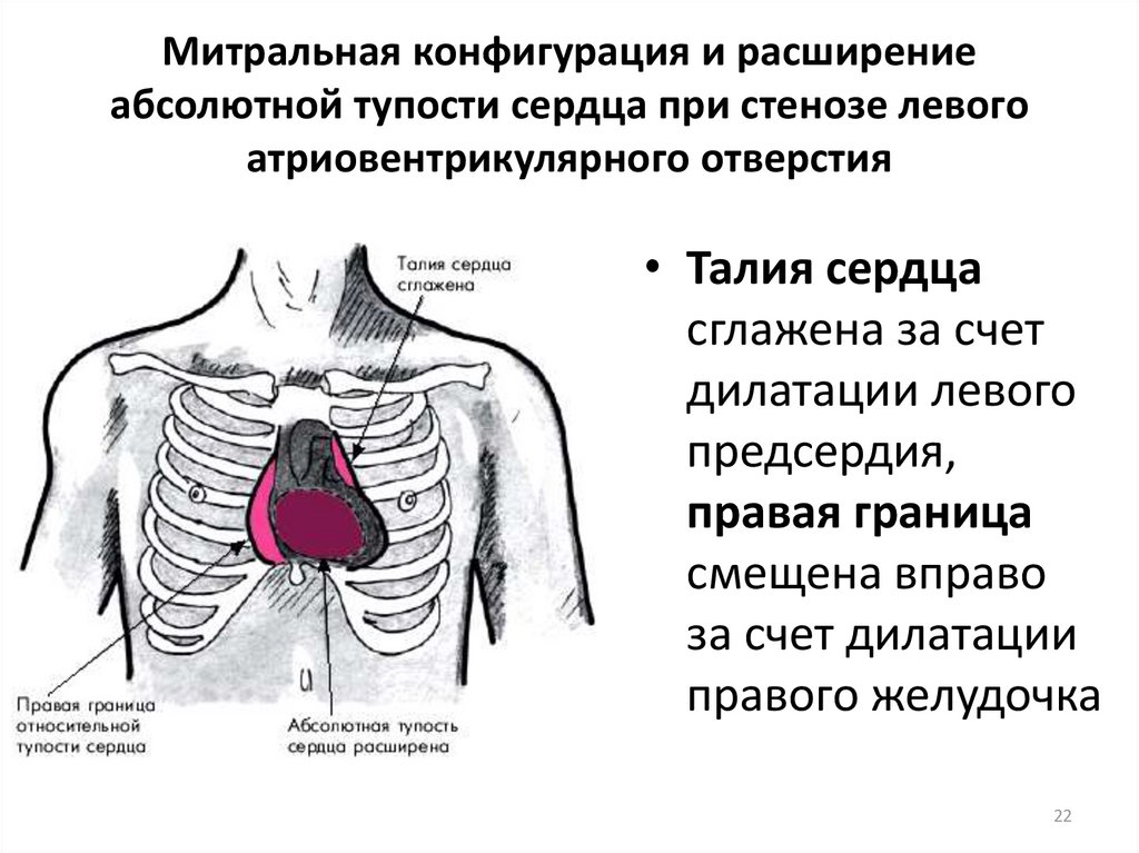 Тупость сердца. Абсолютная тупость сердца при митральном стенозе. Митральная конфигурация сердца при митральном стенозе. Перкуссия сердца Относительная и абсолютная тупость сердца. Перкуссия сердца границы абсолютной и относительной тупости сердца.