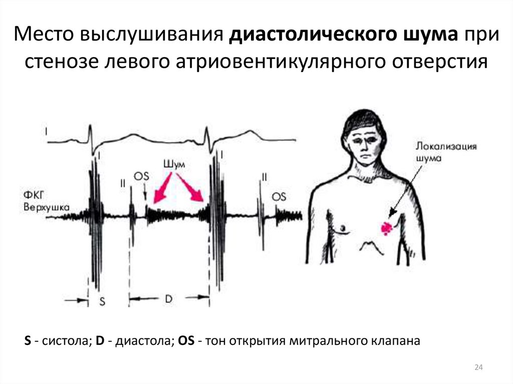 Место выслушивания митрального клапана