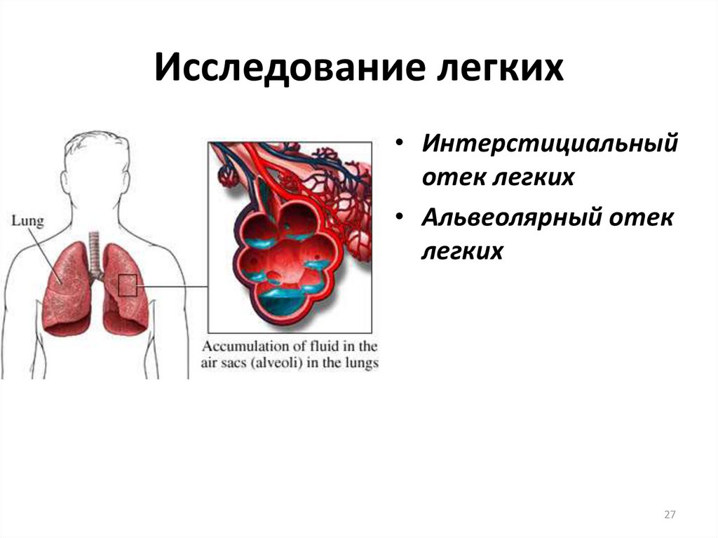 Исследование легких. Интерстициального и альвеолярного отека легкого. Интерстициальный и альвеолярный отек легких. Интерстициальный отек легких.