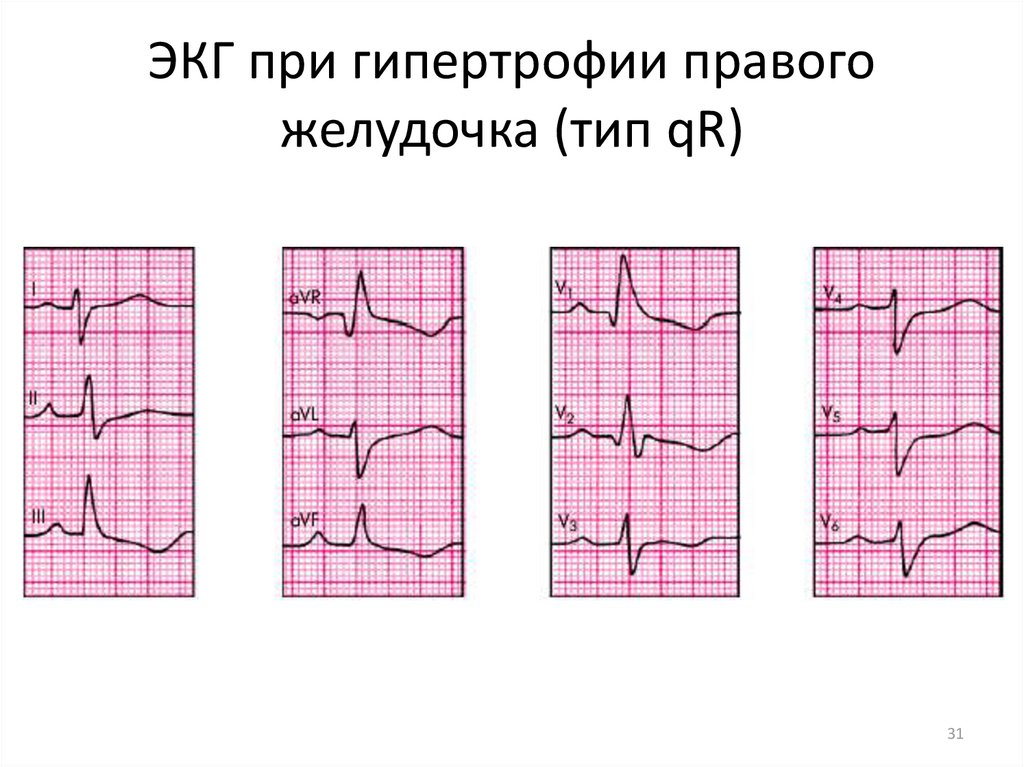 Гипертрофия правого желудочка