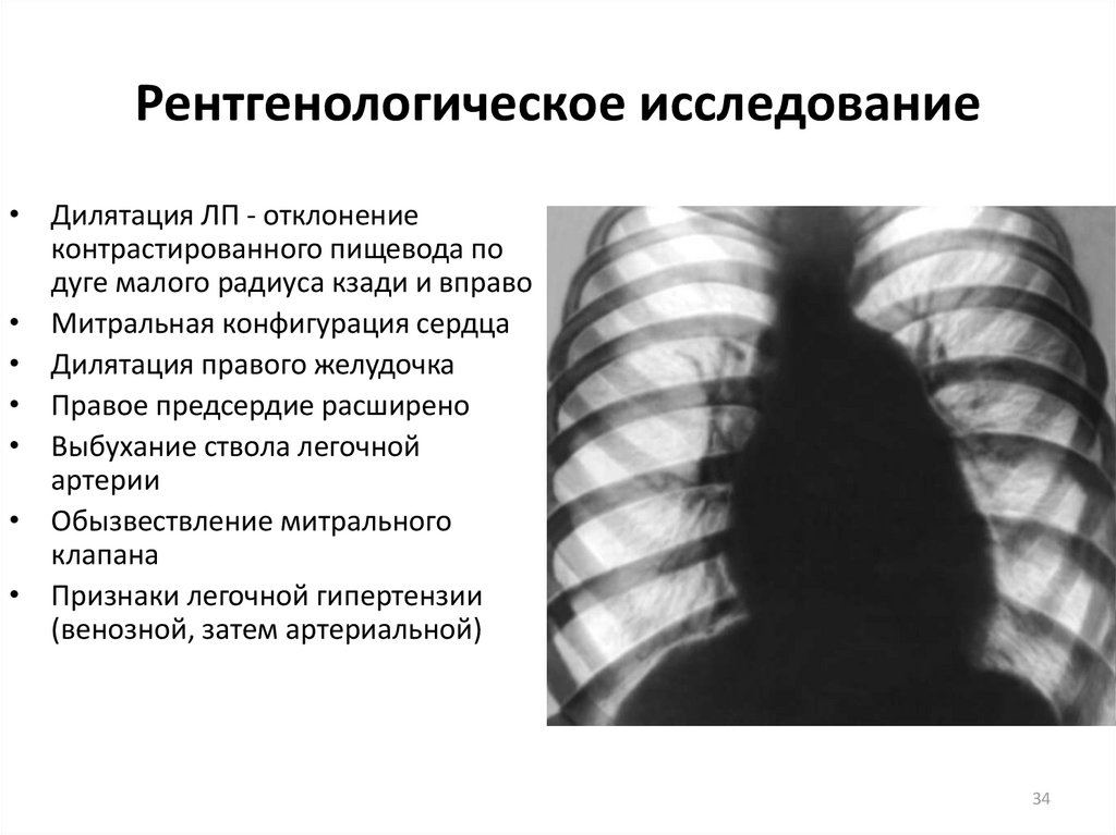 Митральная стеноз презентация