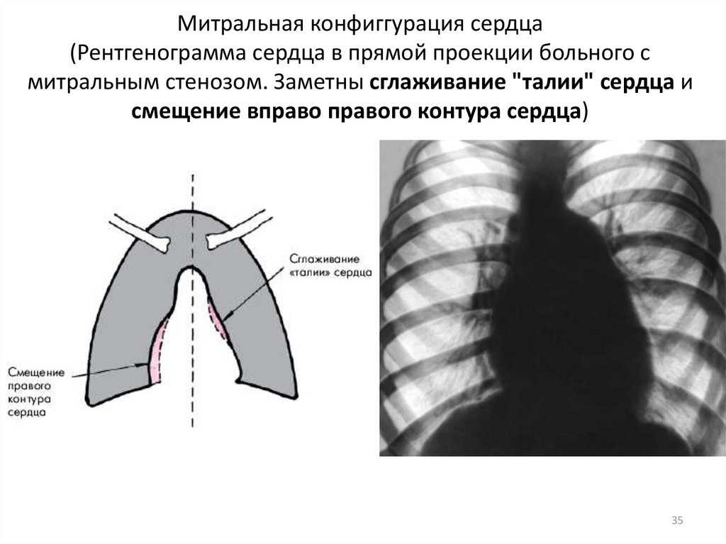 Аортальная конфигурация сердца схема