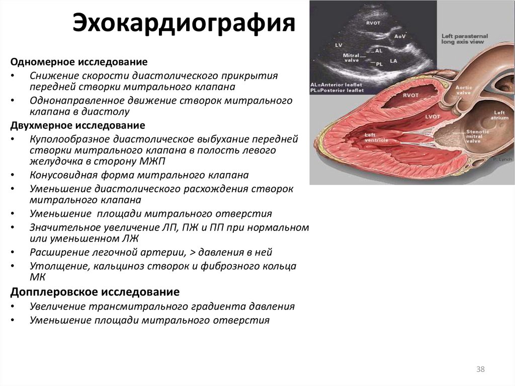 Митральный аортальный стеноз. Стеноз аортального клапана эхокардиография. Кальциноз митрального клапана ЭХОКГ. ЭХОКГ эндокардит митрального клапана заключение. Стеноз митрального клапана на ЭХОКГ.