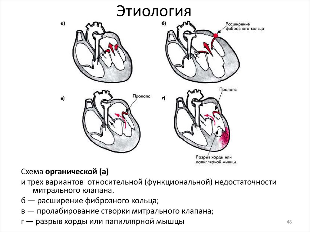 Стеноз митрального клапана