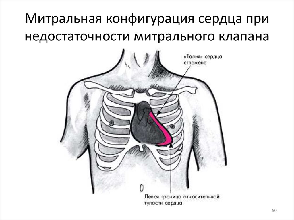 Недостаточность митрального клапана студфайл