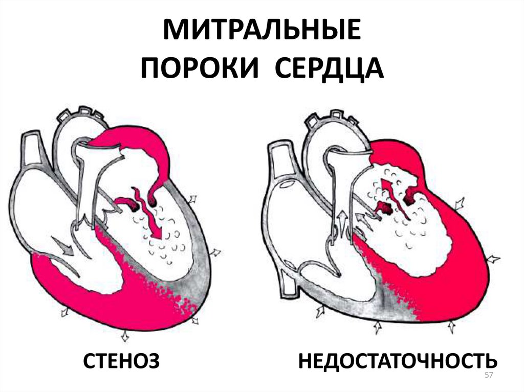 Сердечный стеноз. Недостаточность митрального клапана схема. Пороки сердца митральные пороки. Приобретенные пороки сердца схема. Стеноз митрального клапана схема.