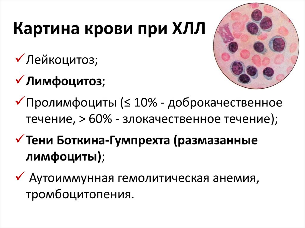 Изменение клеток крови. Хронический лимфоцитарный лейкоз картина крови. Картина крови при хроническом лимфолейкозе. Острый лимфобластный лейкоз тени Боткина Гумпрехта.