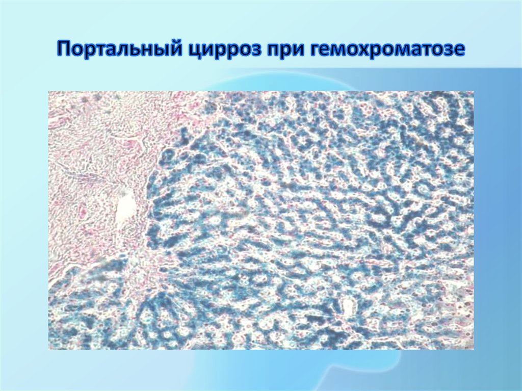 Портальный цирроз при гемохроматозе