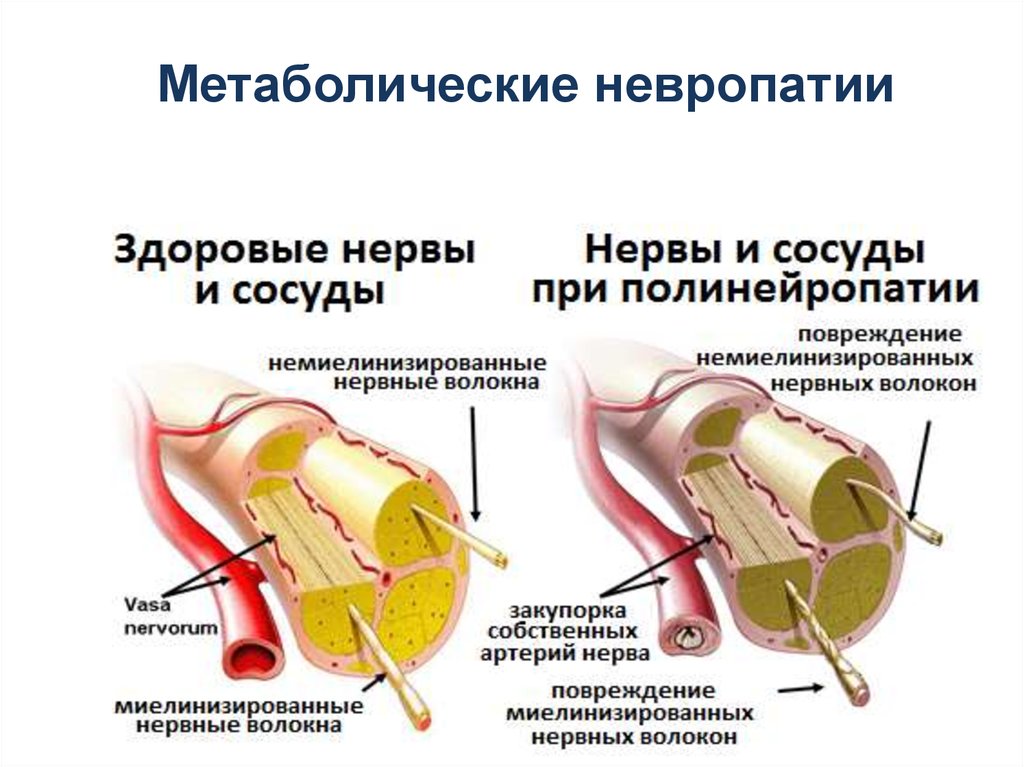 Дифтерийная полинейропатия. Метаболическая полинейропатия нижних конечностей. Дифтерийная полиневропатия. Дифтерийные полинейропатии. Осложнения полиневропатии.