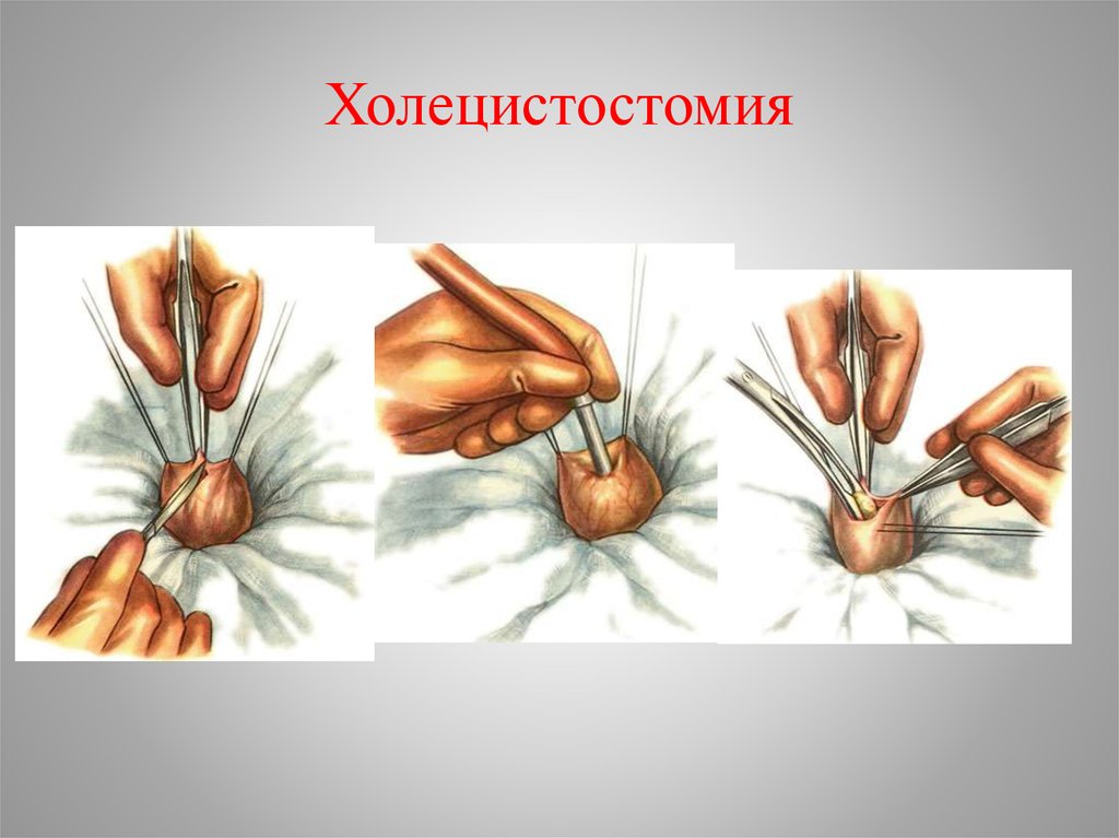 Для эхографической картины острого холецистита характерно тест