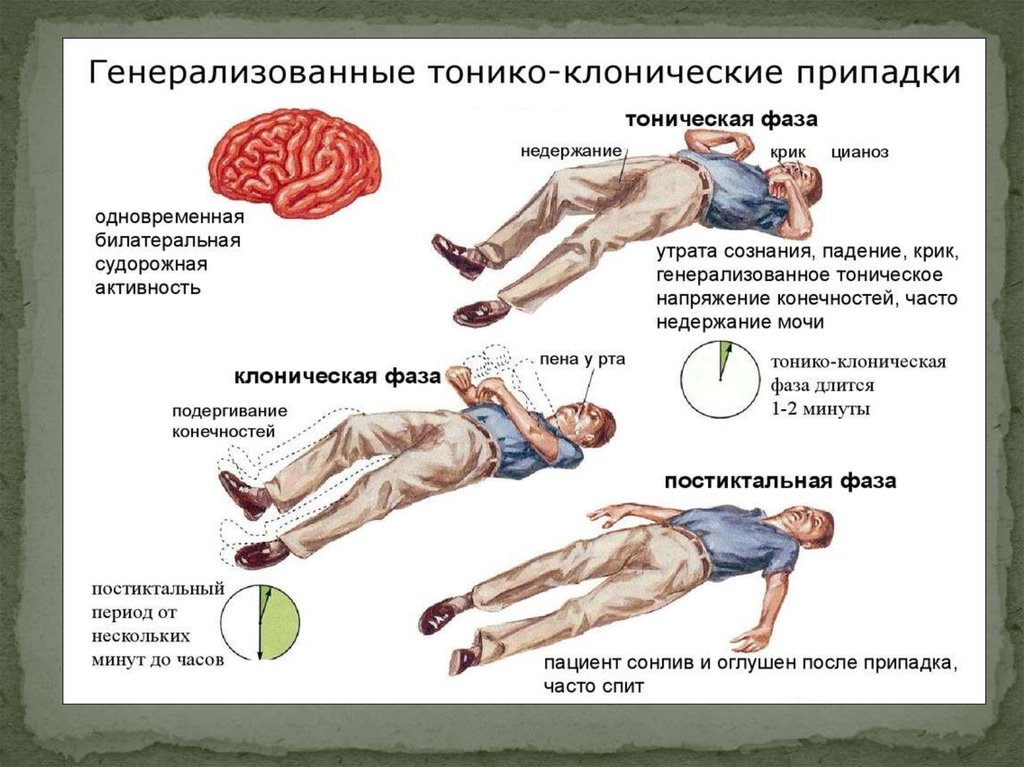 Судорожный синдром презентация