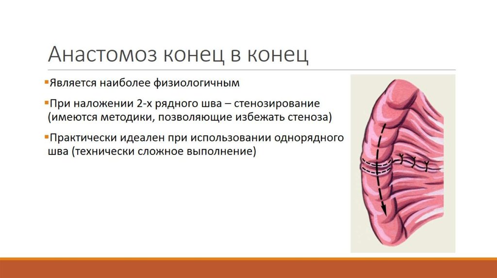 Анастомоз конец в конец