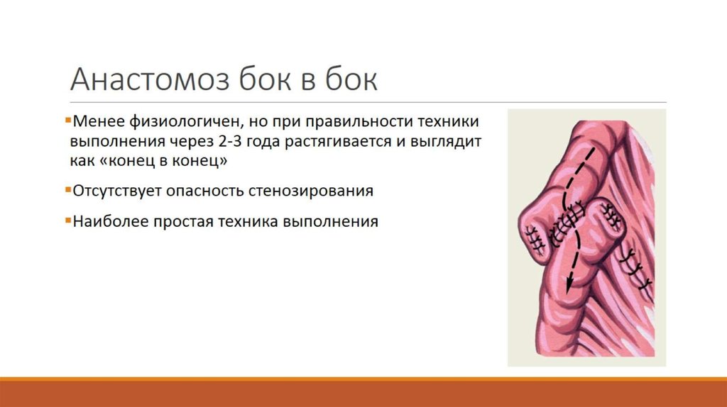 Анастомоз бок в бок