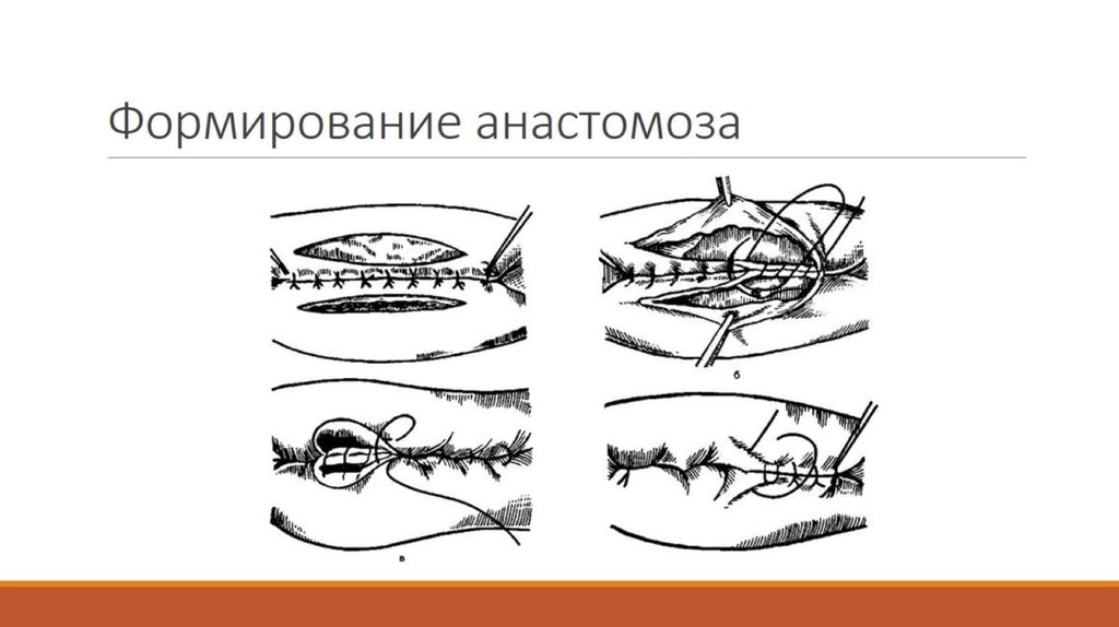 Формирование анастомоза