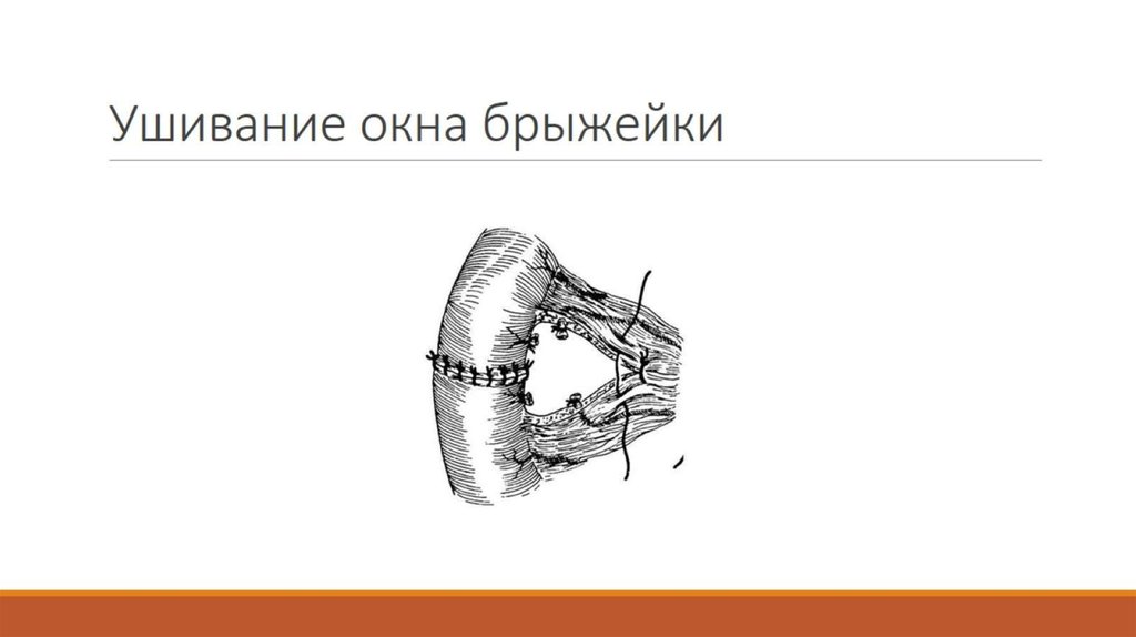 Ушивание окна брыжейки