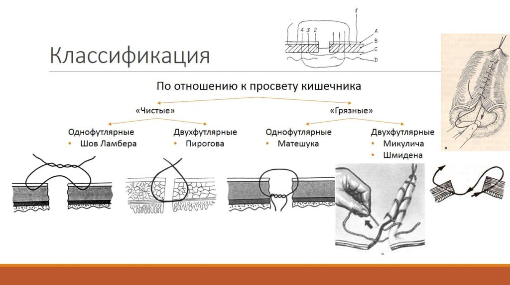 Кишечный шов презентация