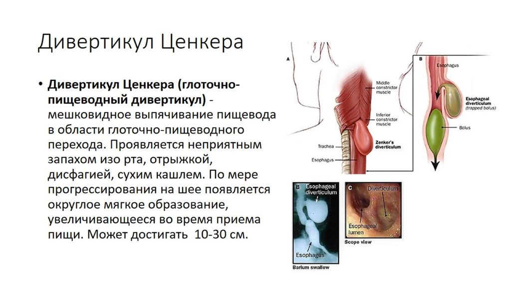 Дивертикул пищевода. Глоточно-пищеводный дивертикул. Дивертикулы пищевода Цинкера. Ценкеровский дивертикул пищевода локализуется. Дивертикул Ценкера рентген описание.