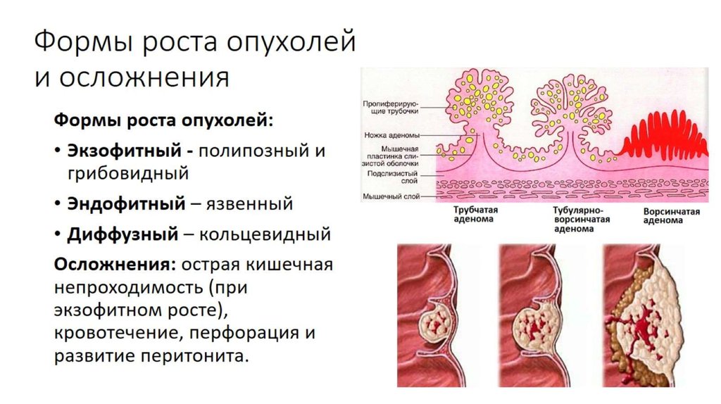 Формы роста злокачественных опухолей. Типы роста опухолей схема. Эндофитный рост опухоли