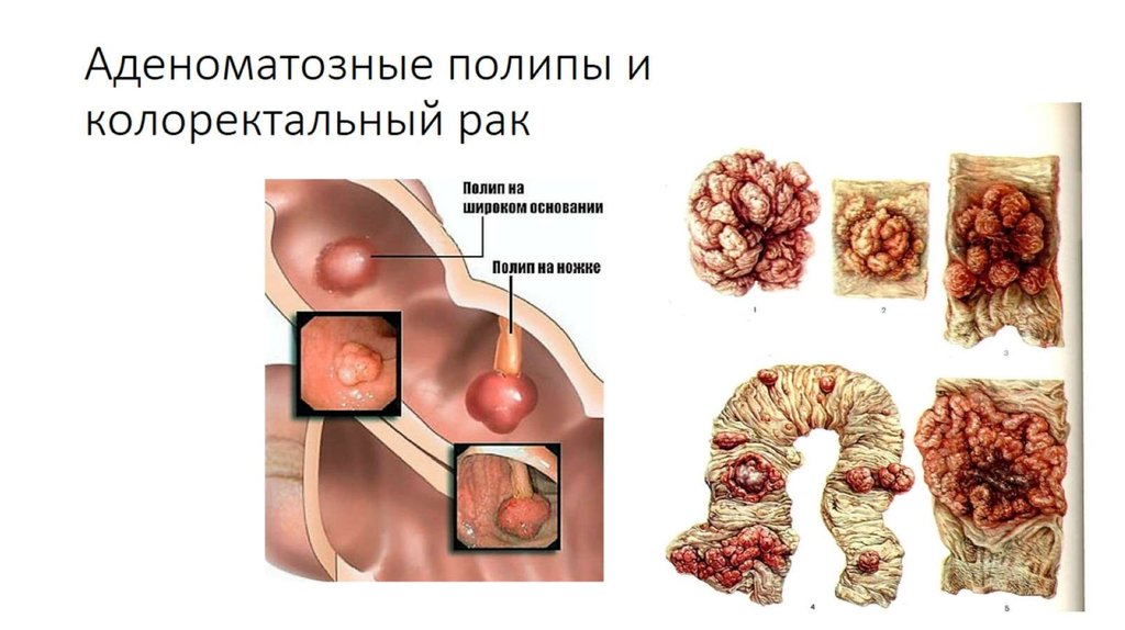 Аденоматозные полипы и колоректальный рак