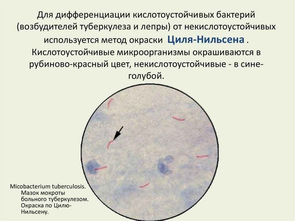 Туберкулез кокки. Метод окраски кислотоустойчивых бактерий по Цилю-Нильсену. Окраска кислотоустойчивых бактерий по Цилю Нильсену. Микроскопия по Цилю Нильсену туберкулез. Кислотоустойчивые бактерии по Цилю Нильсену.