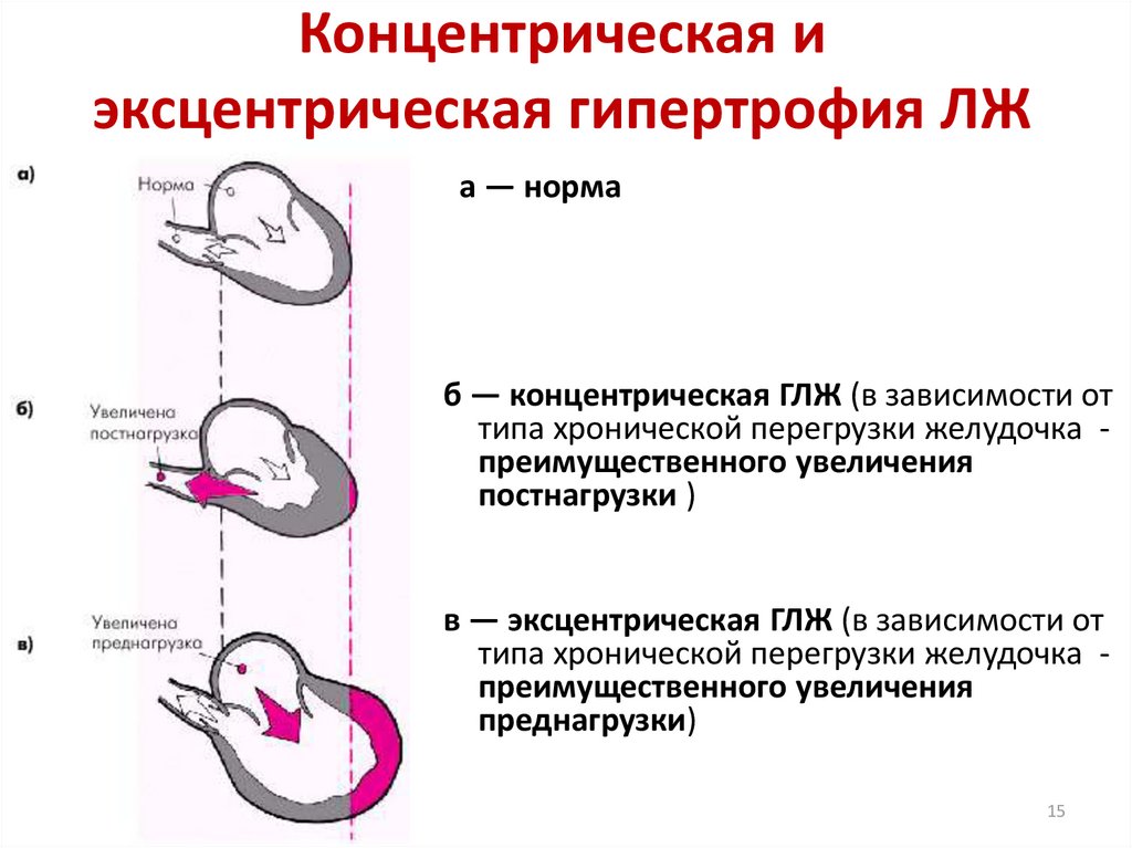 Миокарда левого. Концентрическая и эксцентрическая гипертрофия левого желудочка. Эксцентрический Тип гипертрофии миокарда. Критерии гипертрофии миокарда лж. Эксцентрическая гипертрофия левого желудочка сердца.