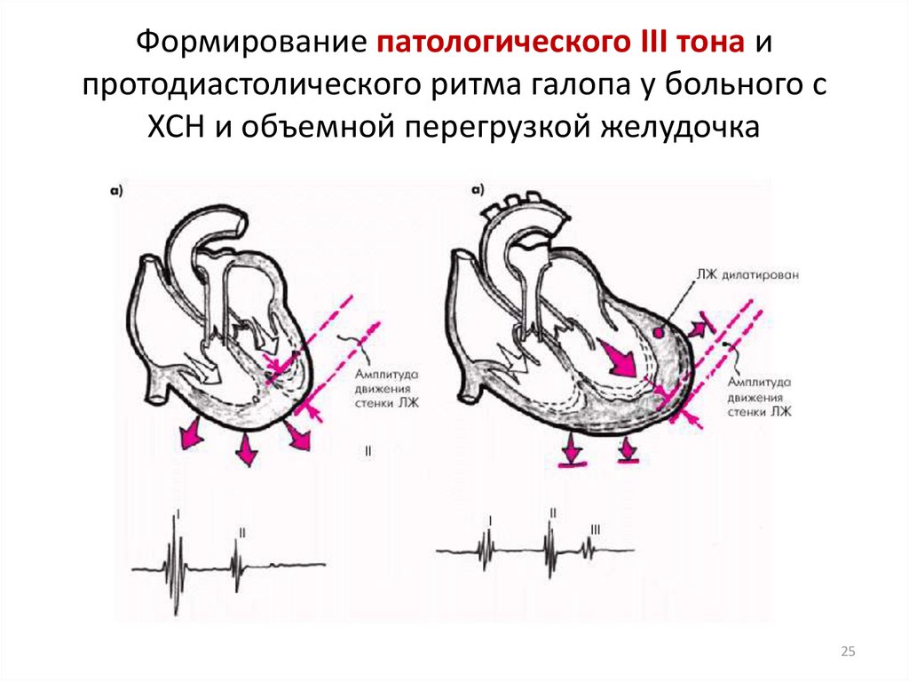 Схема ритма галопа