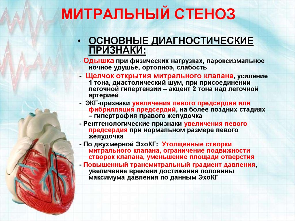 Митральный стеноз картинка