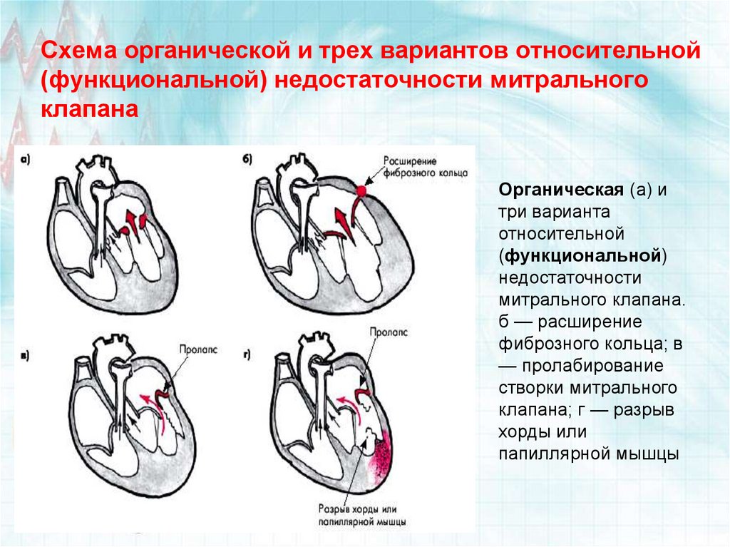 Сердечная недостаточность митрального клапана. Приобретенный порок сердца митральная недостаточность. Приобретенные пороки сердца схема гемодинамики. Митральная недостаточность схема. Приобретённые пороки сердца недостаточность митрального клапана.