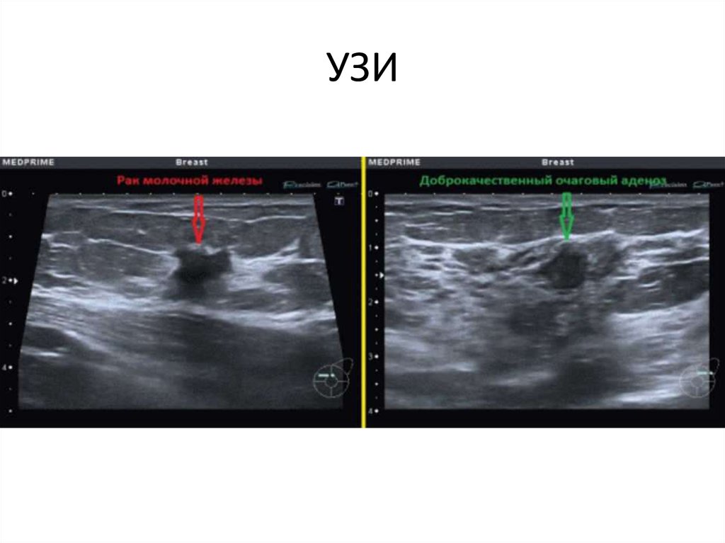 Виден ли рак. Аденоз молочных желез на УЗИ. Фиброаденома доброкачественная опухоль молочной железы УЗИ. УЗИ картина аденоза молочной железы. Аденоз молочной железы на УЗИ.