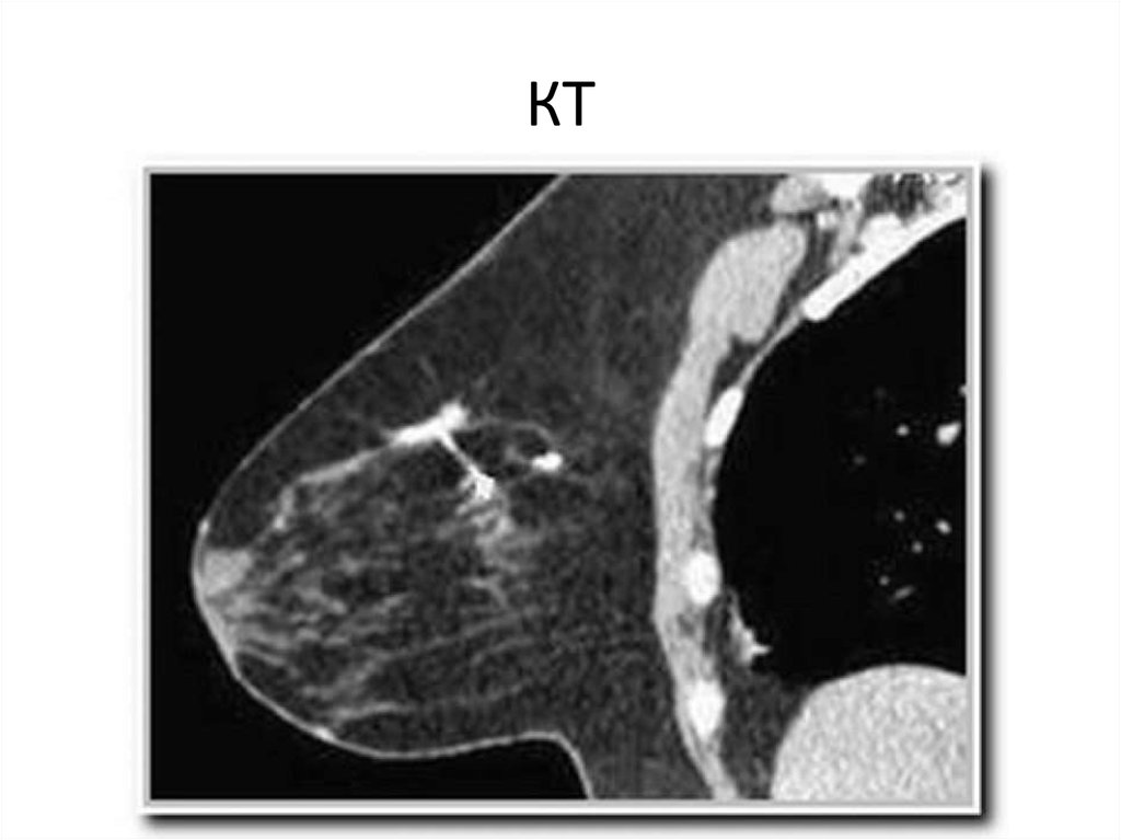 На кт виден рак. Магнитно-резонансная томография молочных желёз. Доброкачественная опухоль молочной железы на кт. Кт при онкологии молочной железы.