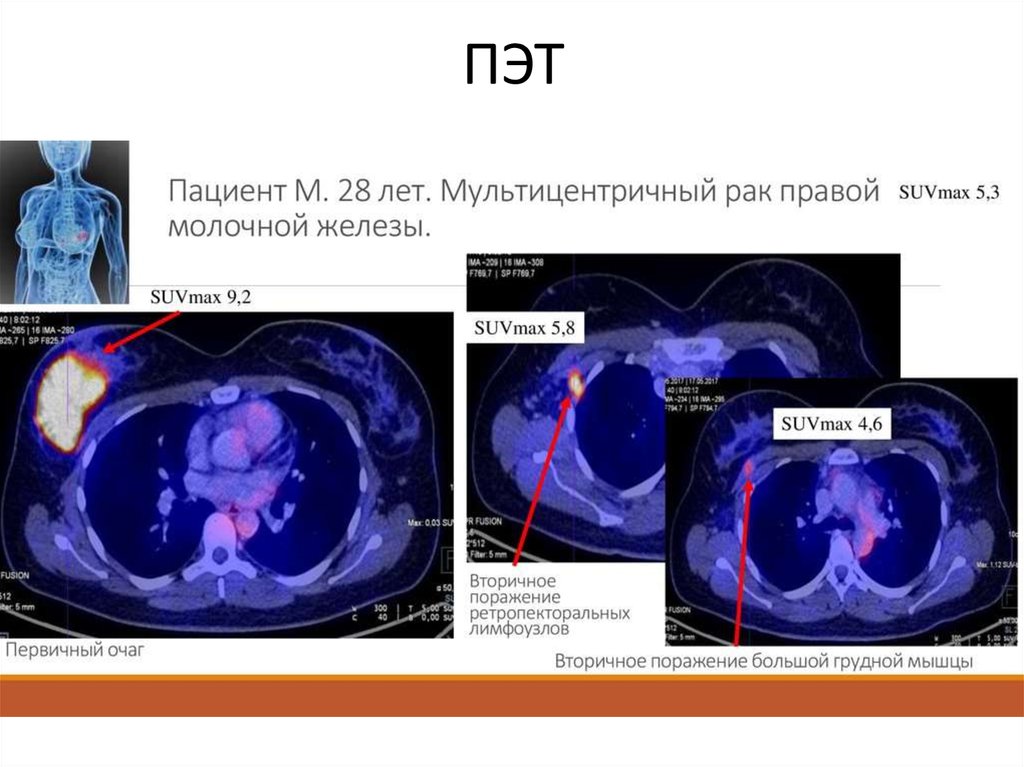 Пэт кт что это при онкологии