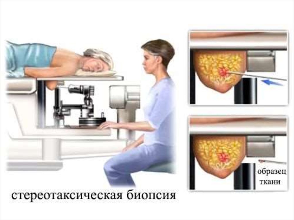 Биопсия железы. Гистологическое исследование молочной железы биопсийный материал. Стереотаксическая биопсия молочной железы. Стереотаксическая Core биопсия молочной железы. Стереотаксическая пункция молочной железы это.