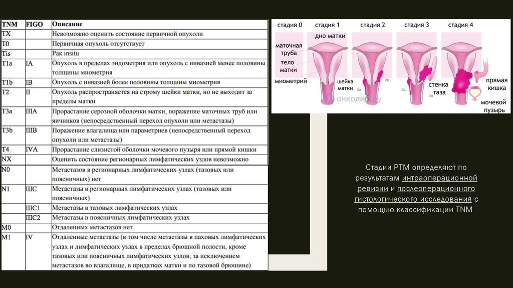 Размеры эндометрия матки. Степени онкологии шейки матки. Опухоли тела матки классификация. Классификация TNM опухолей матки.