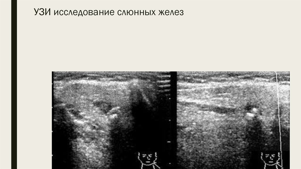 Лучевая диагностика заболеваний слюнных желез презентация