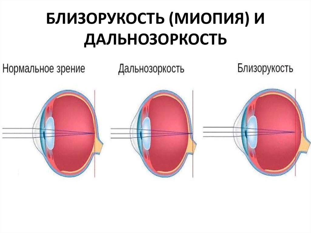 Нормальное зрение. Строение глаза близорукость и дальнозоркость. Близорукость это миопия а дальнозоркость это. Форма глаза при близорукости и дальнозоркости. Близорукость строение глаза.