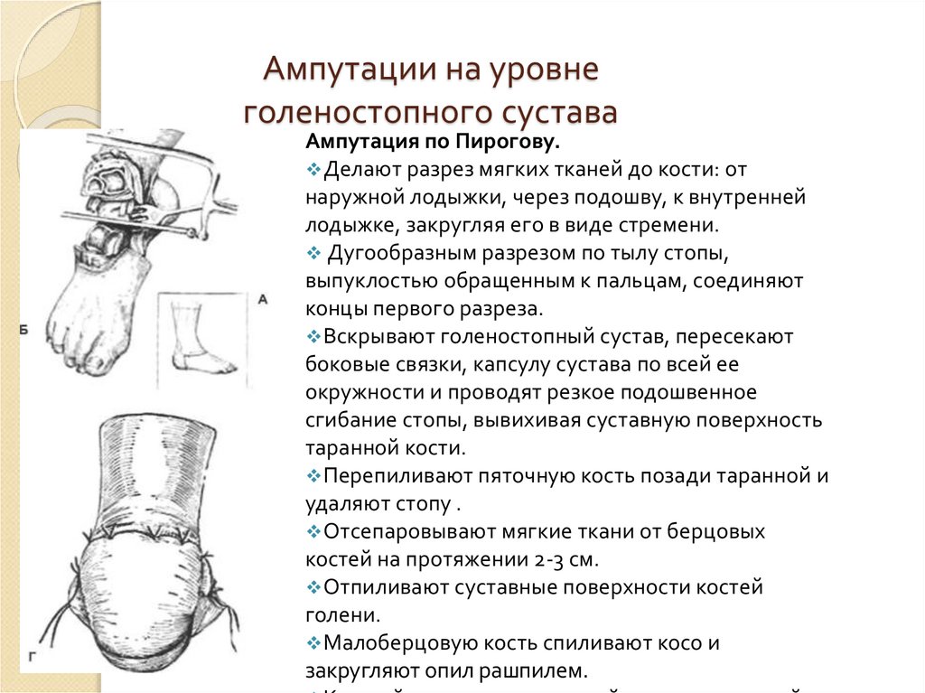 Ампутация на уровне голени