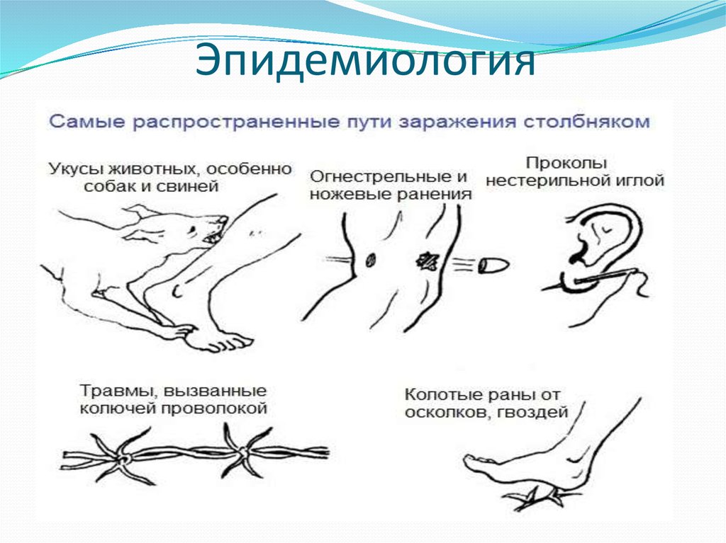 Столбняк признаки. Столбняк механизм и путь заражения. Возбудитель столбняка источник инфекции. Механизм заражения столбняком. Столбняк возбудитель пути передачи симптомы.