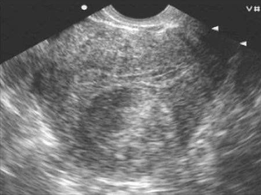 Эндометрий 6мм. Эндометриоидная миома матки. УЗИ картина эндометриоза. Эндометриоз яичника на УЗИ.