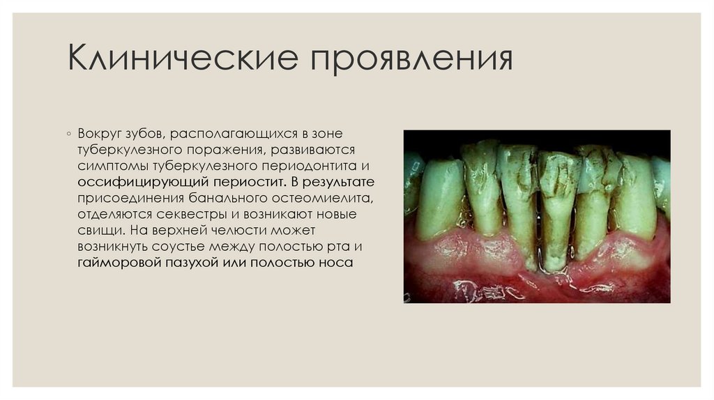 Клинические проявления