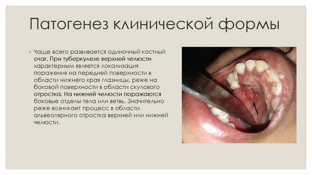 Патогенез клинической формы