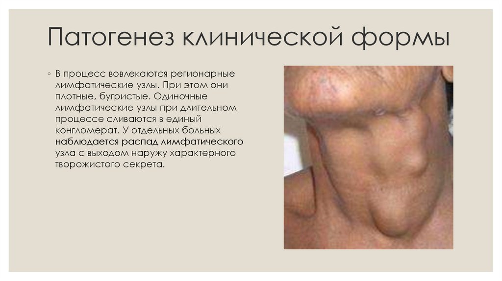 Патогенез клинической формы