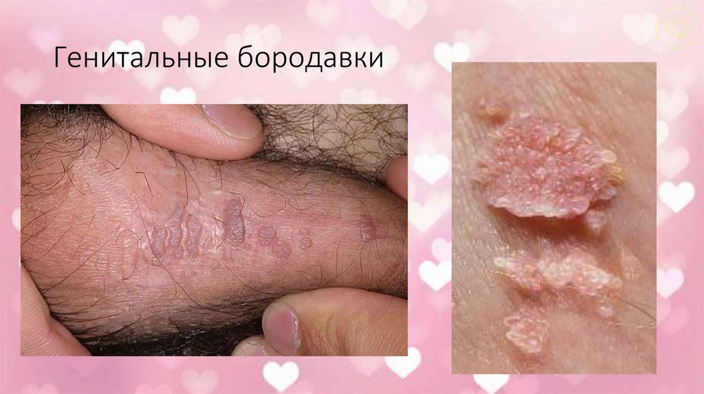 Генитальные бородавки