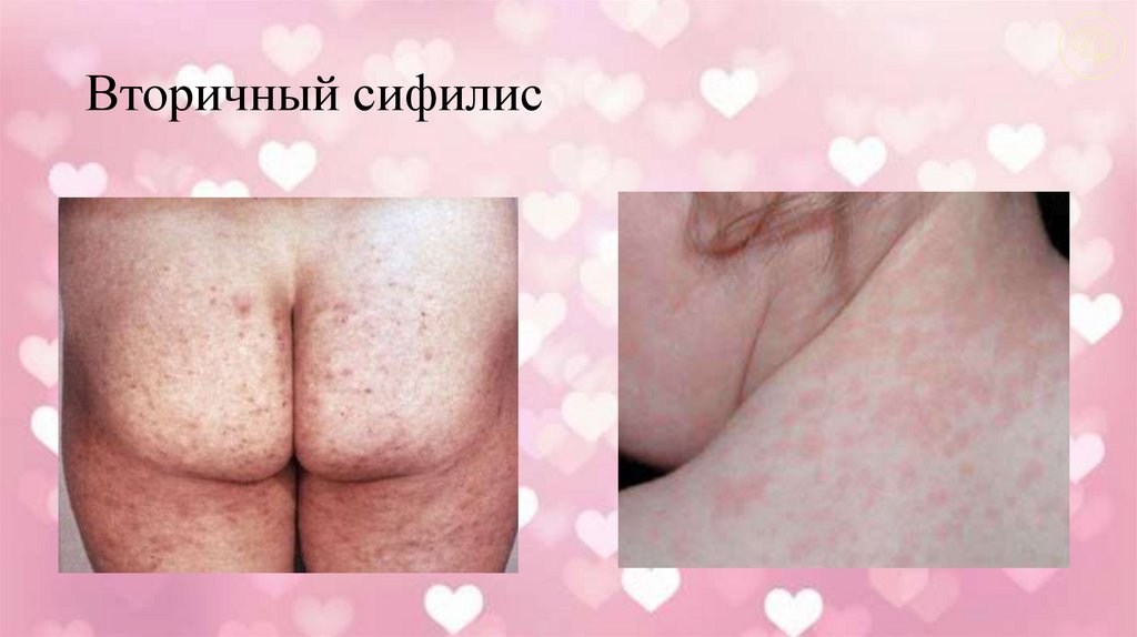 Вторичный сифилис