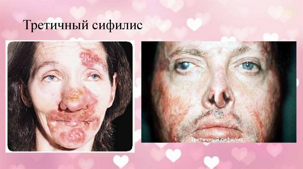 Третичный сифилис