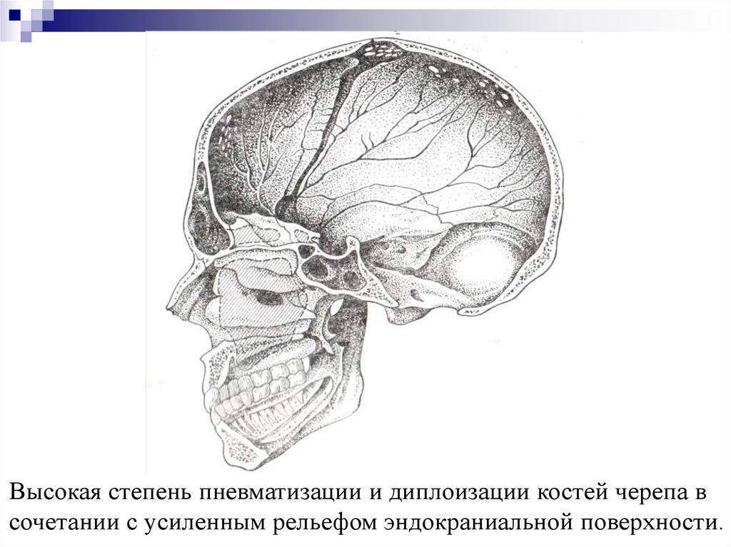 Пневматизация височной кости. Пневматизация костей черепа это. Слабая пневматизация костей черепа. Избыточная пневматизация сосцевидных отростков.