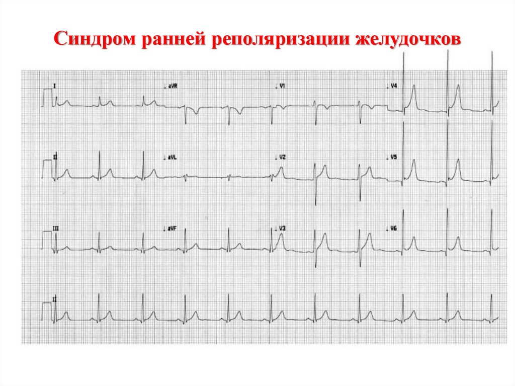 Ранняя реполяризация желудочков. Синдром ранней реполяризации желудочков на ЭКГ. Ранняя реполяризация желудочков сердца на ЭКГ. Реполяризация миокарда желудочков ЭКГ. Ранняя реполяризация желудочков на ЭКГ.