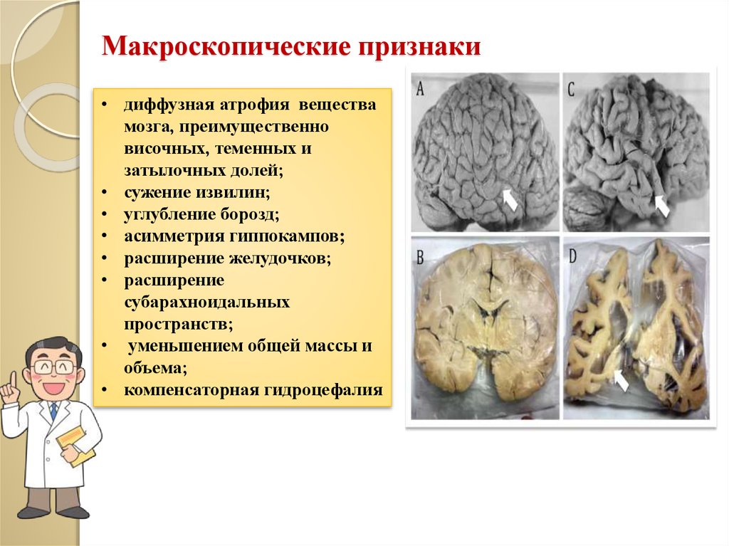 Признаки атрофии мозга. Макроскопические признаки. Макроскопические признаки атрофии. Макроскопические признаки некроза. Диффузная атрофия вещества мозга.