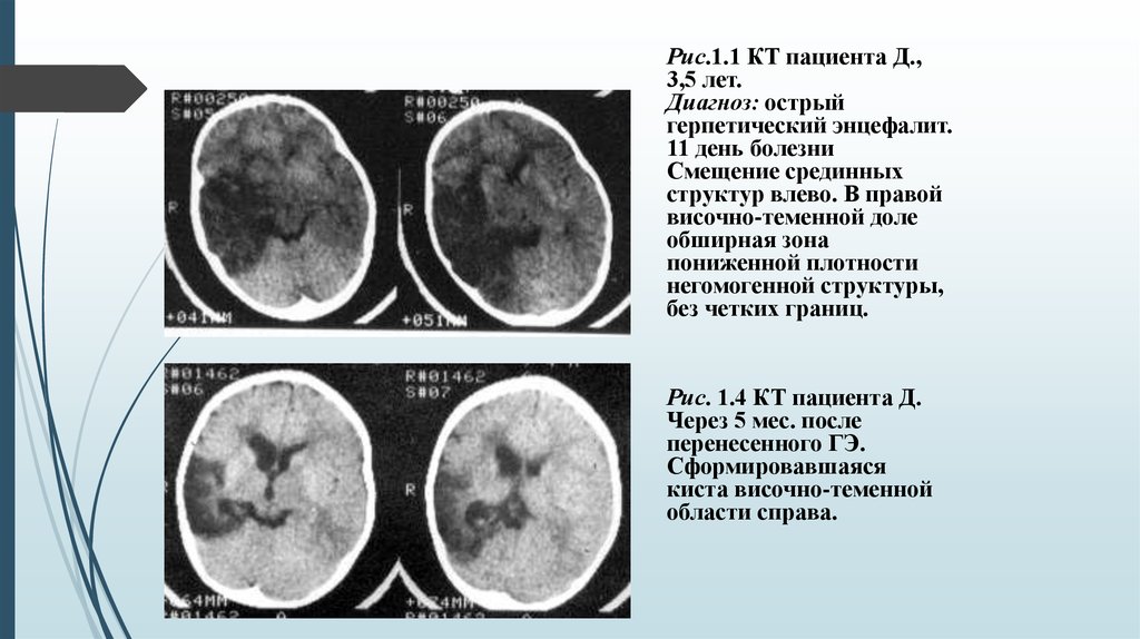 Энцефалит головного мозга у взрослых. Кт при герпетическом энцефалите. Энцефалит головного мозга клиника. Герпетический энцефалит патологическая анатомия.